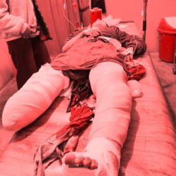 विद्यालयबाट घर फर्किरहेकी ११ वर्षीया बालिकालाई ढुङ्गा लाग्यो, दुबै खुट्टा भाँचिए