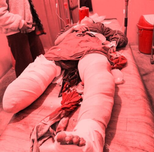 विद्यालयबाट घर फर्किरहेकी ११ वर्षीया बालिकालाई ढुङ्गा लाग्यो, दुबै खुट्टा भाँचिए